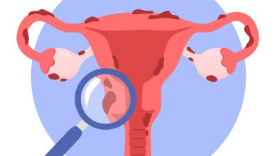 Endometriose