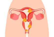 Mioma não é frescura — escute seu corpo
