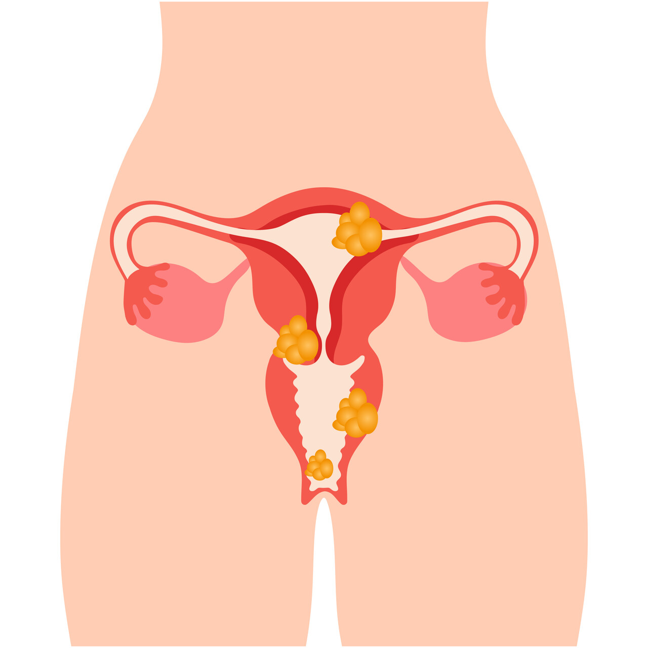 Mioma não é frescura — escute seu corpo