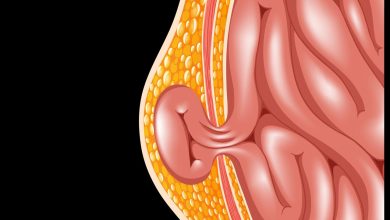 Hérnia inguinal quando a ‘bolinha na virilha’ pode virar caso de urgência