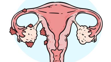 Endometriose quando a cólica deixa de ser normal