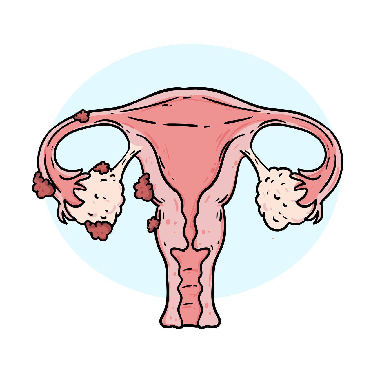 Endometriose quando a cólica deixa de ser normal