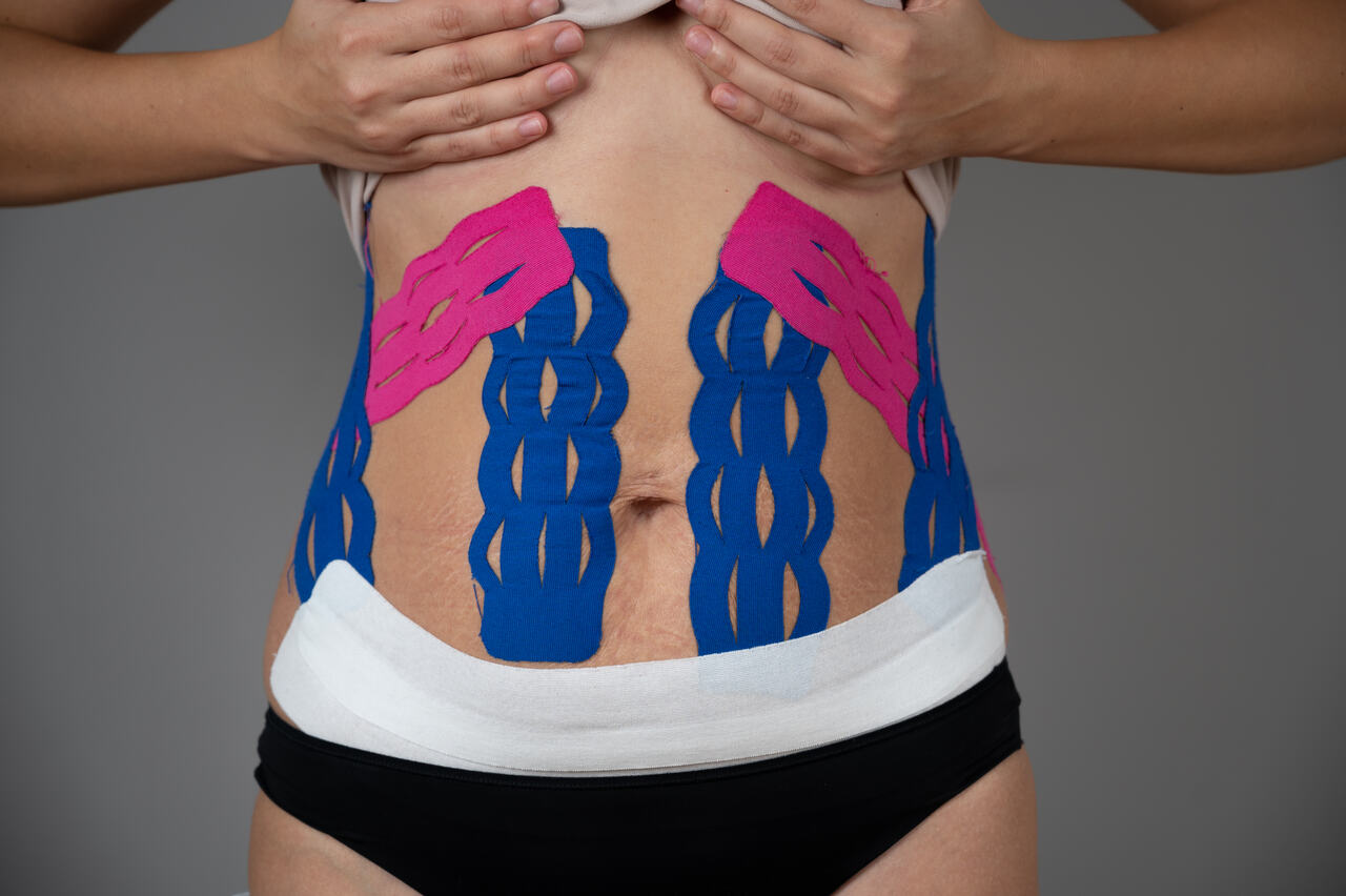 Taping no pós-parto: uma aliada na recuperação da mulher