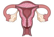 Nova lei da laqueadura muda tudo o que toda mulher precisa saber