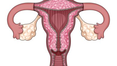 Nova lei da laqueadura muda tudo o que toda mulher precisa saber