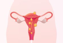 Mioma impede a gravidez Entenda quando ele interfere