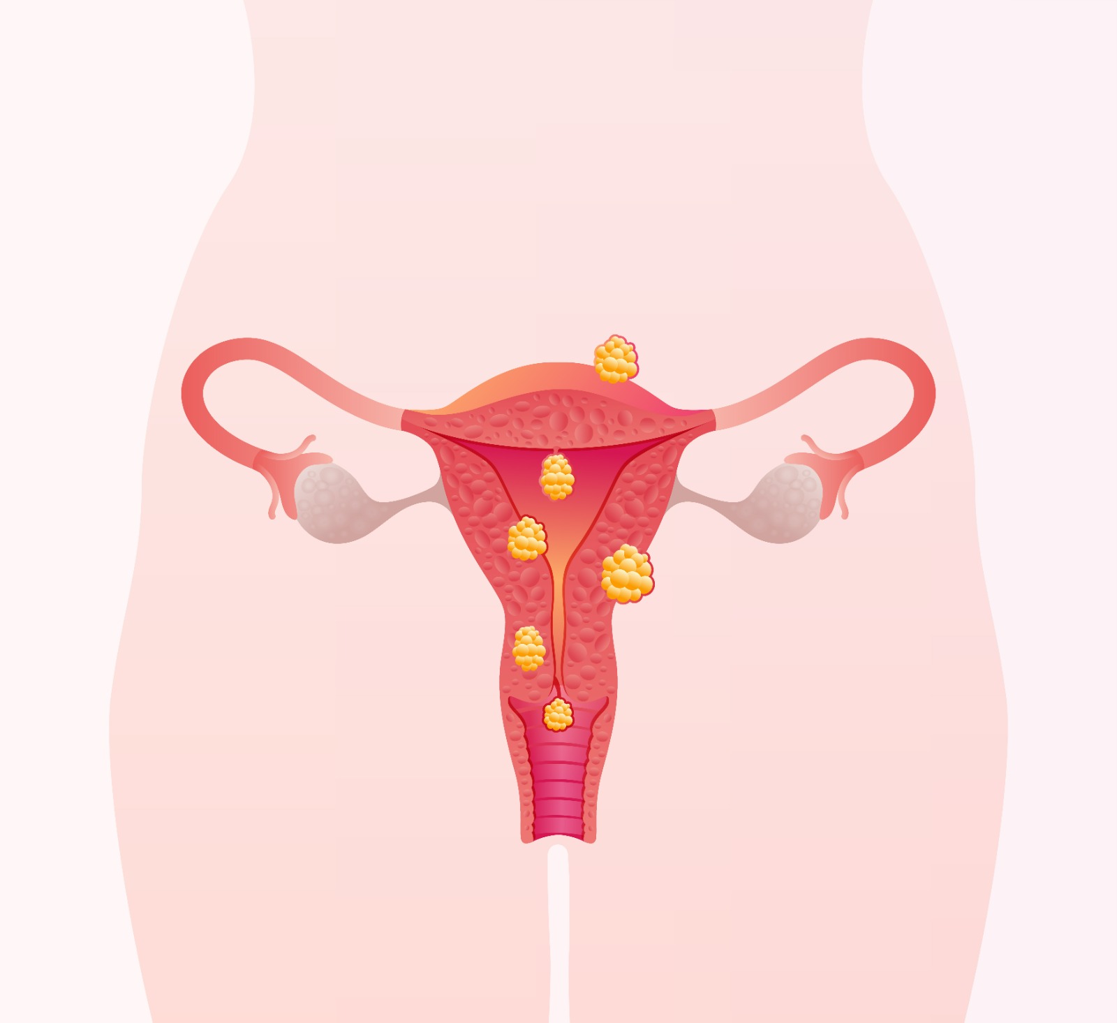 Mioma impede a gravidez Entenda quando ele interfere