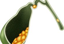 Mitos sobre pedra na vesícula que colocam a saúde em risco