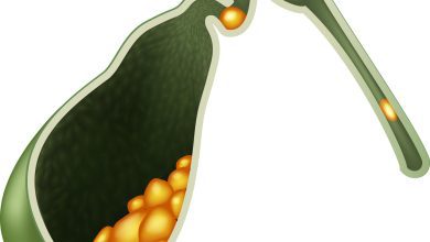 Mitos sobre pedra na vesícula que colocam a saúde em risco