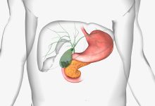 Pedra na vesícula não surge por acaso: entenda os fatores de risco